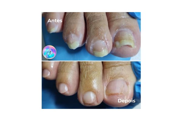 Foto de antes e depois do tratamento 8